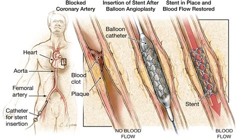 Stents to Treat Coronary Artery Blockages | Cardiology | JAMA | The JAMA Network