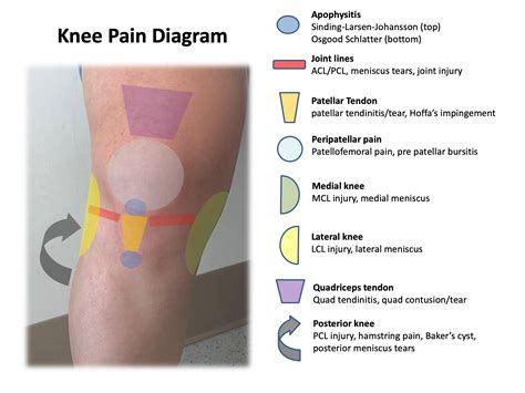 Knee Diagram Meniscus Pain