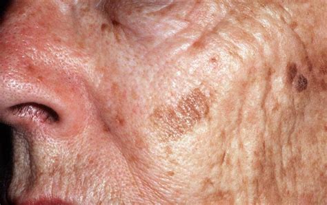 Age Spots - Causes, How To Get Rid, Cream & Treatment