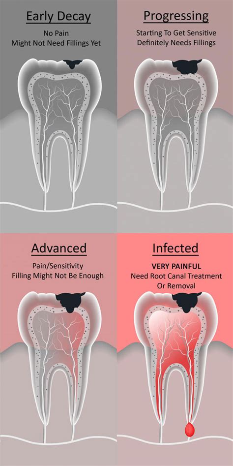 Tooth Decay - Berwick Dental Studio | Dentist Berwick | Invisalign Berwick | Cosmetic Dentistry ...