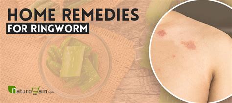 8 DIY Home Remedies for Ringworm Treatment that Work