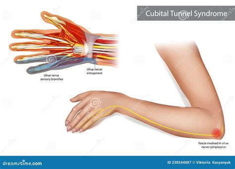 Ulnar Nerve Entrapment