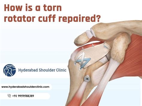 Do And Don'ts After Rotator Cuff Surgery