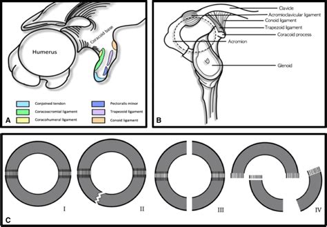 a The coracoid process and its attached anatomical structures (superior... | Download Scientific ...