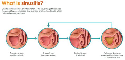 Ear Clogged Sinus Symptoms