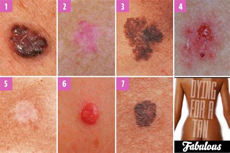 Can you spot which moles are deadly? The skin cancer signs you need to know – The Irish Sun