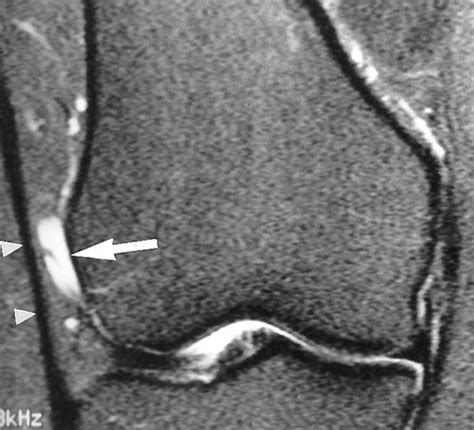 Iliotibial Band Mri