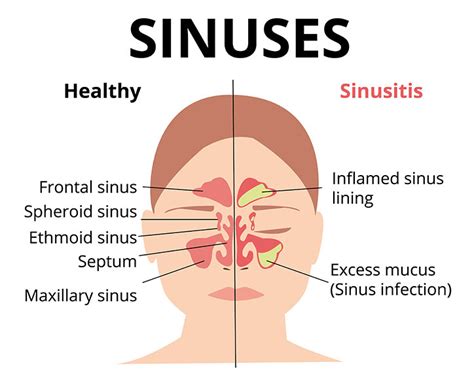 What Causes Swollen Nasal Passages