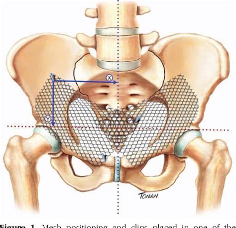 [PDF] Mesh Displacement After Bilateral Inguinal Hernia Repair With No Fixation | Semantic Scholar