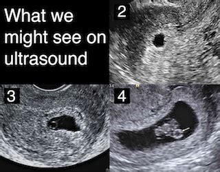 5 1 2 Weeks Pregnant Ultrasound Pictures - PictureMeta