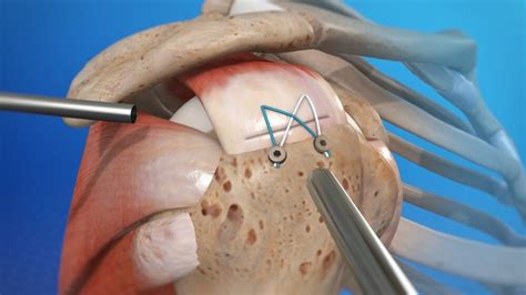 rotator cuff surgery — Gormack Orthopaedics