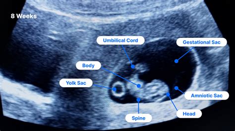 8-Week Ultrasound: Pictures, Fetus Size, Twins and More