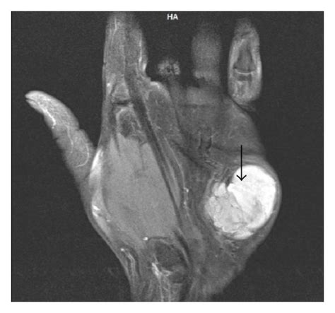 Synovial sarcoma. MRI (of the same patient as Figure 8). On T2W images... | Download Scientific ...