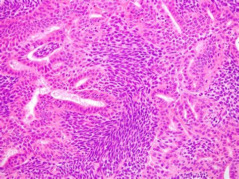 Synovial Sarcoma Histology