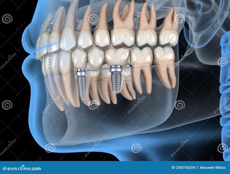 Recovery with Dental Implants. Medically Accurate 3D Illustration of Human Teeth and Dentures ...