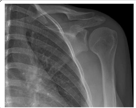 AP radiograph of the nondisplaced pathologic coracoid process fracture. | Download Scientific ...