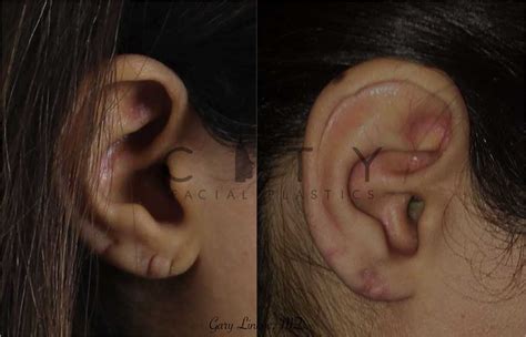 NYC Ear Lobe Repair Before and After Pictures | New York | UES