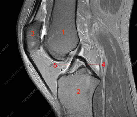 Normal Mri Knee