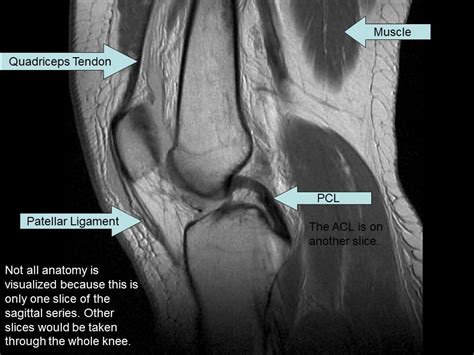 Knee Muscle Anatomy Mri : Mri Knee Anatomy Knee Sagittal Anatomy Free Cross Sectional Anatomy ...