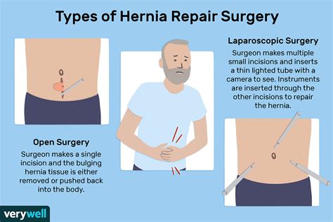 How To Fix Umbilical Hernia - Braincycle1