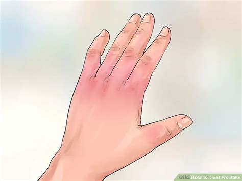 How to Treat Frostbite | Frostbite, Frostbite remedies, Health guide