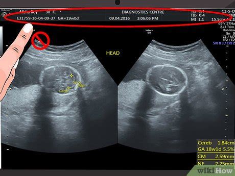 How to Read an Ultrasound Picture: 9 Steps (with Pictures)