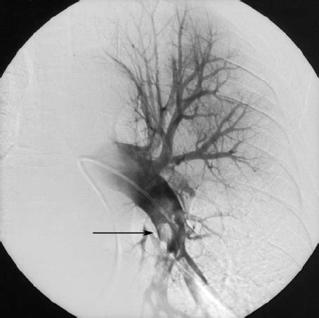 Pulmonary angiogram (digital subtraction angiography) revealing large... | Download Scientific ...