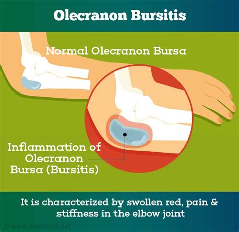 Olecranon Bursitis Presentation And Treatment Bone And Spine