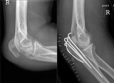 Olecranon Fractures - Pathophysiology - Management - TeachMeSurgery