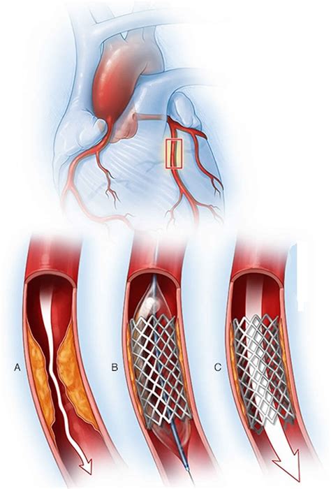 PTCA procedure, percutaneous coronary angioplasty, benefits & risks