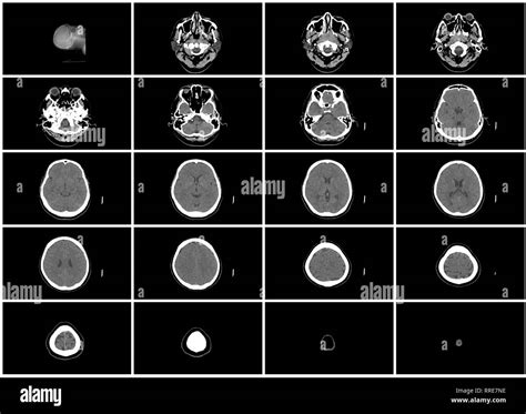 Ct head scan hi-res stock photography and images - Alamy