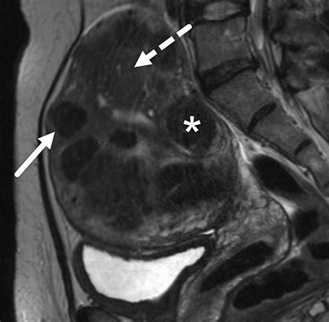 Sagittal T2-weighted image showing an intramural uterine fibroid that... | Download Scientific ...