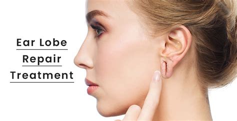 Ear lobe repair in Ahmedabad, Earlobe Repair Treatment | iVA Skin & Laser Center