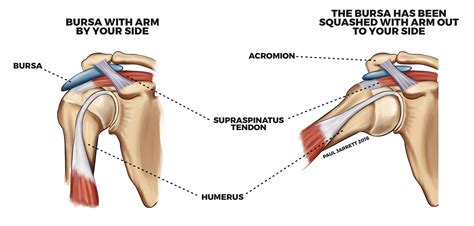 Subacromial-bursitis – PHYSIOCURE