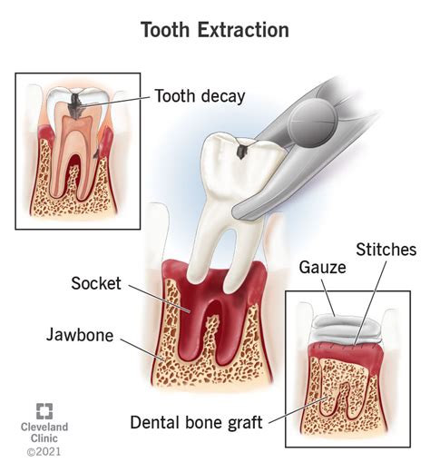 Decayed Tooth Extraction