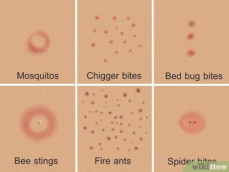 Chigger Bites Vs Bed Bug Bites