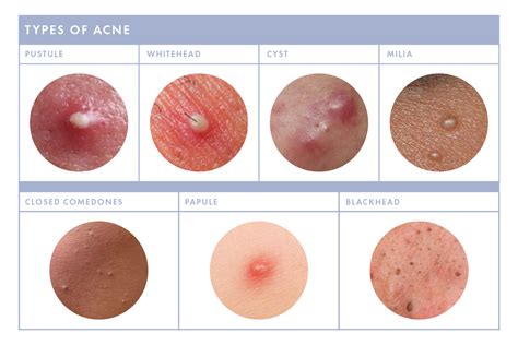 Pustule Vs Papule