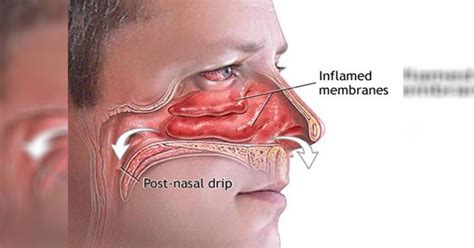 1 Simple Trick That Will Clear Your Clogged Sinuses In A Few Seconds – Useful Tips For Home