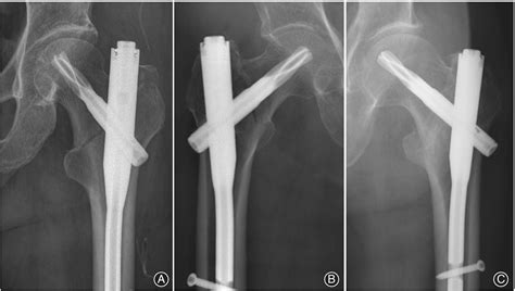 Proximal Fem Nail On X Ray - Nail Ftempo