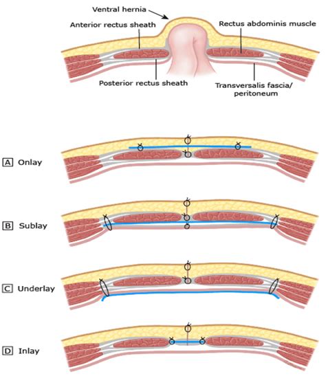 Umbilical Hernia - General & Bariatric Surgery of South Florida | Dr. Alvaro Garcia