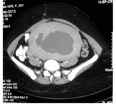 MRI (cross section): a large intramural leiomyoma with areas of cystic... | Download Scientific ...