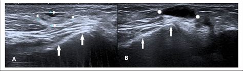 Figure 1 from Cystic Degeneration of an Atypical Adventitial Bursitis: Case Report and ...