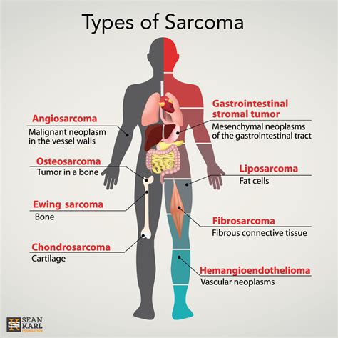 Soft Tissue Sarcoma Types