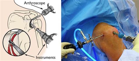 Rotator Cuff Tear: Treatment Options: Colorado Sports Medicine & Orthopaedics: Orthopaedics