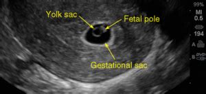 Fetal Pole - radiologystar