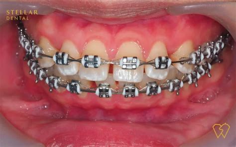 Braces Colors: Top Picks For 2023 - Stellar Dental