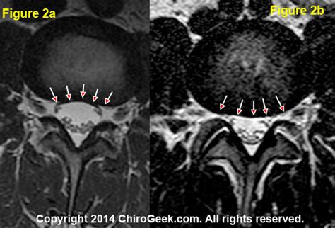 Disc bulge, Back pain, Sciatica by a World-Renowned Spine Expert | ChiroGeek.com