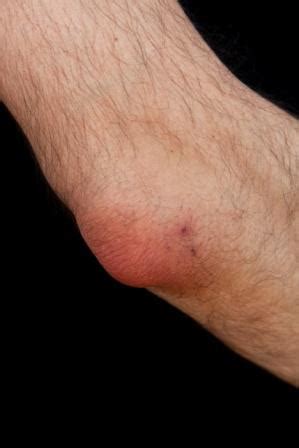 Student's Elbow: Olecranon Bursitis Causes, Symptoms, Treatment