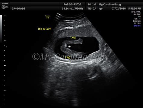 Gender Reveal Ultrasound in Charlotte, NC | My Carolina Baby