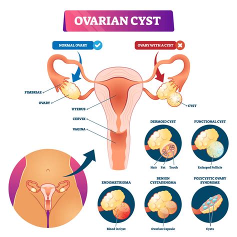 Ovarian Cysts: What Are They & What Are The Treatment Options?